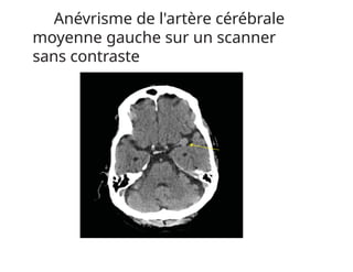 Anévrisme de l'artère cérébrale
moyenne gauche sur un scanner
sans contraste
 