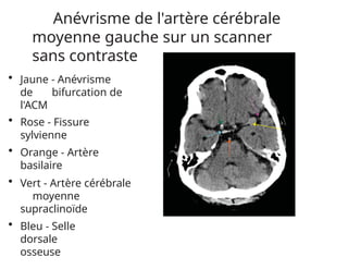 Anévrisme de l'artère cérébrale
moyenne gauche sur un scanner
sans contraste
• Jaune - Anévrisme
de bifurcation de
l'ACM
• Rose - Fissure
sylvienne
• Orange - Artère
basilaire
• Vert - Artère cérébrale
moyenne
supraclinoïde
• Bleu - Selle
dorsale
osseuse
 