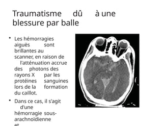 Traumatisme dû à une
blessure par balle
• Les hémorragies
aiguës sont
brillantes au
scanner, en raison de
l'atténuation accrue
des photons des
rayons X par les
protéines sanguines
lors de la formation
du caillot.
• Dans ce cas, il s'agit
d'une
hémorragie sous-
arachnoïdienne
 
