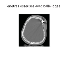 Fenêtres osseuses avec balle logée
 
