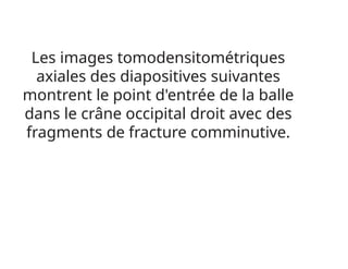Les images tomodensitométriques
axiales des diapositives suivantes
montrent le point d'entrée de la balle
dans le crâne occipital droit avec des
fragments de fracture comminutive.
 