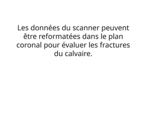 Les données du scanner peuvent
être reformatées dans le plan
coronal pour évaluer les fractures
du calvaire.
 