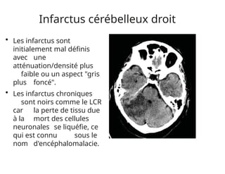 Infarctus cérébelleux droit
• Les infarctus sont
initialement mal définis
avec une
atténuation/densité plus
faible ou un aspect "gris
plus foncé".
• Les infarctus chroniques
sont noirs comme le LCR
car la perte de tissu due
à la mort des cellules
neuronales se liquéfie, ce
qui est connu sous le
nom d'encéphalomalacie.
 