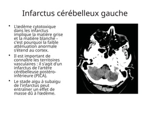 Infarctus cérébelleux gauche
• L'œdème cytotoxique
dans les infarctus
implique la matière grise
et la matière blanche -
c'est pourquoi la faible
atténuation anormale
s'étend au cortex.
• Il est important de
connaître les territoires
vasculaires : il s'agit d'un
infarctus de l'artère
cérébelleuse postéro-
inférieure (PICA).
• Le stade aigu à subaigu
de l'infarctus peut
entraîner un effet de
masse dû à l'œdème.
 