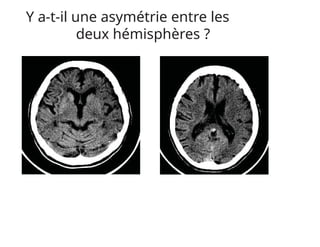 Y a-t-il une asymétrie entre les
deux hémisphères ?
 
