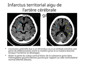 Infarctus territorial aigu de
l'artère cérébrale
moyenne gauche
• L'occlusion artérielle due à un thrombus ou à un embole entraîne une
perte de différenciation entre la matière grise et la matière blanche
lorsque l'ischémie se développe.
• Noter la perte du ruban cortical blanc de la substance grise dans
l'hémisphère gauche (flèches jaunes) par rapport au côté controlatéral
normal (flèches bleues).
 