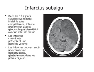 Infarctus subaigu
• Dans les 5 à 7 jours
suivant l'événement
initial, la zone
complètement infarcie
présente un aspect
géographique bien défini
avec un effet de masse.
• Les infarctus
chroniques
présentent une
perte de volume
• Les infarctus peuvent subir
une conversion
hémorragique,
généralement dans les
premiers jours.
 