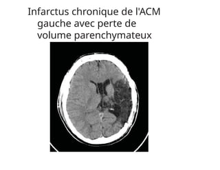 Infarctus chronique de l'ACM
gauche avec perte de
volume parenchymateux
 