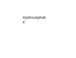 Hydrocéphali
e
 