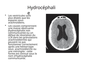 Hydrocéphali
e
• Les ventricules sont
plus dilatés que les
espaces sous-
arachnoïdiens.
• Les causes comprennent
une masse obstruante
(hydrocéphalie non
communicante) ou un
défaut de résorption du
LCR dans les granulations
arachnoïdiennes qui
peuvent ne pas
fonctionner correctement
après une hémorragie
sous- arachnoïdienne ou
une méningite : cette
forme est connue sous le
nom d'hydrocéphalie
communicante.
 