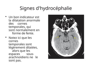 Signes d'hydrocéphalie
• Un bon indicateur est
la dilatation anormale
des cornes
temporales, qui
sont normalement en
forme de fente.
• Notez ici que les
cornes
temporales sont
légèrement dilatées,
alors que les
espaces sous-
arachnoïdiens ne le
sont pas.
 