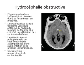 Hydrocéphalie obstructive
• L'hyperdensité de ce
kyste colloïdal bénin est
due à sa forte teneur en
protéines.
• Le kyste est situé dans le
troisième ventricule
antérieur au niveau du
foramen de Monroe et a
entraîné une dilatation des
ventricules latéraux.
• Le patient se plaint
principalement de
céphalées sévères
accompagnées d'une
augmentation de la
pression intracrânienne.
• Une résection
neurochirurgicale
est impérative
 