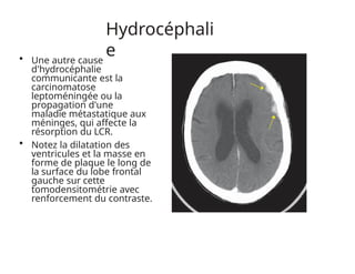 Hydrocéphali
e
• Une autre cause
d'hydrocéphalie
communicante est la
carcinomatose
leptoméningée ou la
propagation d'une
maladie métastatique aux
méninges, qui affecte la
résorption du LCR.
• Notez la dilatation des
ventricules et la masse en
forme de plaque le long de
la surface du lobe frontal
gauche sur cette
tomodensitométrie avec
renforcement du contraste.
 