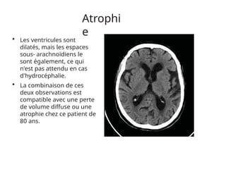 Atrophi
e
• Les ventricules sont
dilatés, mais les espaces
sous- arachnoïdiens le
sont également, ce qui
n'est pas attendu en cas
d'hydrocéphalie.
• La combinaison de ces
deux observations est
compatible avec une perte
de volume diffuse ou une
atrophie chez ce patient de
80 ans.
 