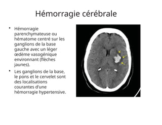 Hémorragie cérébrale
• Hémorragie
parenchymateuse ou
hématome centré sur les
ganglions de la base
gauche avec un léger
œdème vasogénique
environnant (flèches
jaunes).
• Les ganglions de la base,
le pons et le cervelet sont
des localisations
courantes d'une
hémorragie hypertensive.
 