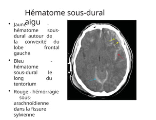 Hématome sous-dural
aigu
• Jaune -
hématome sous-
dural autour de
la convexité du
lobe frontal
gauche
• Bleu -
hématome
sous-dural le
long du
tentorium
• Rouge - hémorragie
sous-
arachnoïdienne
dans la fissure
sylvienne
 