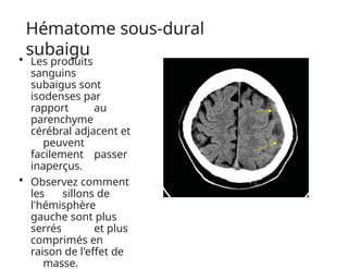 Hématome sous-dural
subaigu
• Les produits
sanguins
subaigus sont
isodenses par
rapport au
parenchyme
cérébral adjacent et
peuvent
facilement passer
inaperçus.
• Observez comment
les sillons de
l'hémisphère
gauche sont plus
serrés et plus
comprimés en
raison de l'effet de
masse.
 