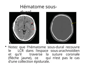 Hématome sous-
dural
• Notez que l'hématome sous-dural recouvre
le LCR dans l'espace sous-arachnoïdien
et qu'il traverse la suture coronale
(flèche jaune), ce qui n'est pas le cas
d'une collection épidurale.
 