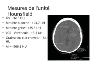 Mesures de l'unité
Hounsfield
• Os~ +613 HU
• Matière blanche~ +24,7 UH
• Matière grise~ +35,8 UH
• LCR - Ventricule~ +3,3 UH
• Graisse du cuir chevelu~ -84.5
HU
• Air~ -966,3 HU
 
