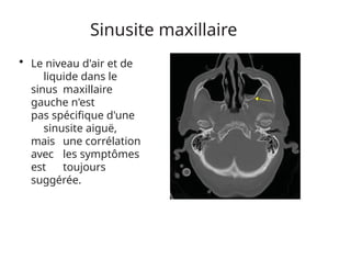 Sinusite maxillaire
• Le niveau d'air et de
liquide dans le
sinus maxillaire
gauche n'est
pas spécifique d'une
sinusite aiguë,
mais une corrélation
avec les symptômes
est toujours
suggérée.
 
