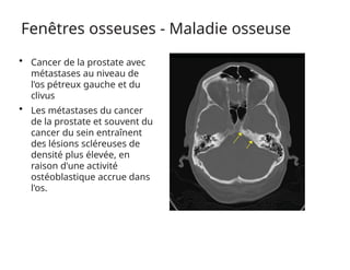 Fenêtres osseuses - Maladie osseuse
• Cancer de la prostate avec
métastases au niveau de
l'os pétreux gauche et du
clivus
• Les métastases du cancer
de la prostate et souvent du
cancer du sein entraînent
des lésions scléreuses de
densité plus élevée, en
raison d'une activité
ostéoblastique accrue dans
l'os.
 