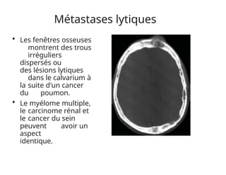 Métastases lytiques
• Les fenêtres osseuses
montrent des trous
irréguliers
dispersés ou
des lésions lytiques
dans le calvarium à
la suite d'un cancer
du poumon.
• Le myélome multiple,
le carcinome rénal et
le cancer du sein
peuvent avoir un
aspect
identique.
 