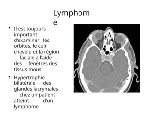 Lymphom
e
• Il est toujours
important
d'examiner les
orbites, le cuir
chevelu et la région
faciale à l'aide
des fenêtres des
tissus mous.
• Hypertrophie
bilatérale des
glandes lacrymales
chez un patient
atteint d'un
lymphome
 