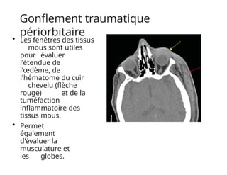 Gonflement traumatique
périorbitaire
• Les fenêtres des tissus
mous sont utiles
pour évaluer
l'étendue de
l'œdème, de
l'hématome du cuir
chevelu (flèche
rouge) et de la
tuméfaction
inflammatoire des
tissus mous.
• Permet
également
d'évaluer la
musculature et
les globes.
 