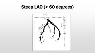 Steep LAO (> 60 degrees)
 