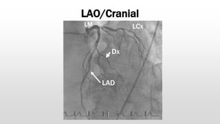 LAO/Cranial
LAD
Dx
LCx
LM
 