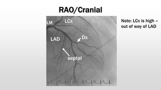 RAO/Cranial
LAD Dx
LCx
LM
septal
Note: LCx is high –
out of way of LAD
 