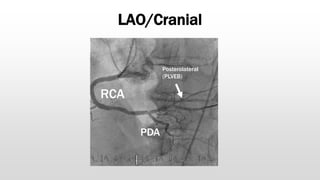 LAO/Cranial
RCA
PDA
Posterolateral
(PLVEB)
 