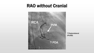 RAO without Cranial
? Posterolateral
(PLVEB)
RCA
? PDA
? Posterolateral
(PLVEB)
RVM
 