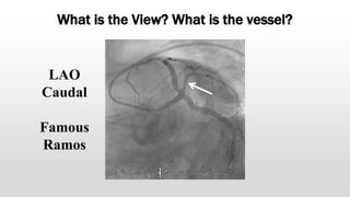 What is the View? What is the vessel?
LAO
Caudal
Famous
Ramos
 