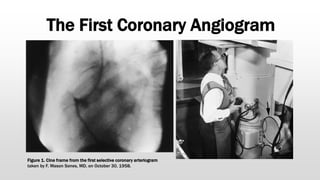 Figure 1. Cine frame from the first selective coronary arteriogram
taken by F. Mason Sones, MD, on October 30, 1958.
The First Coronary Angiogram
 