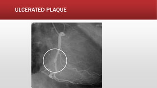 ULCERATED PLAQUE
 