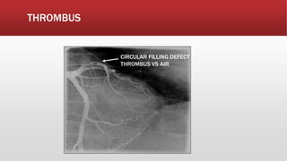 THROMBUS
CIRCULAR FILLING DEFECT
THROMBUS VS AIR
 