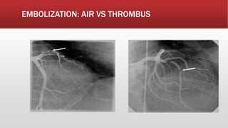 EMBOLIZATION: AIR VS THROMBUS
 