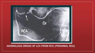 ANOMALOUS ORIGIN OF LCX FROM RCC (PROXIMAL RCA)
 
