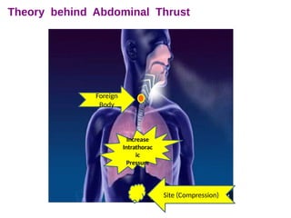 Increase
Intrathorac
ic
Pressure
Site (Compression)
Foreign
Body
 