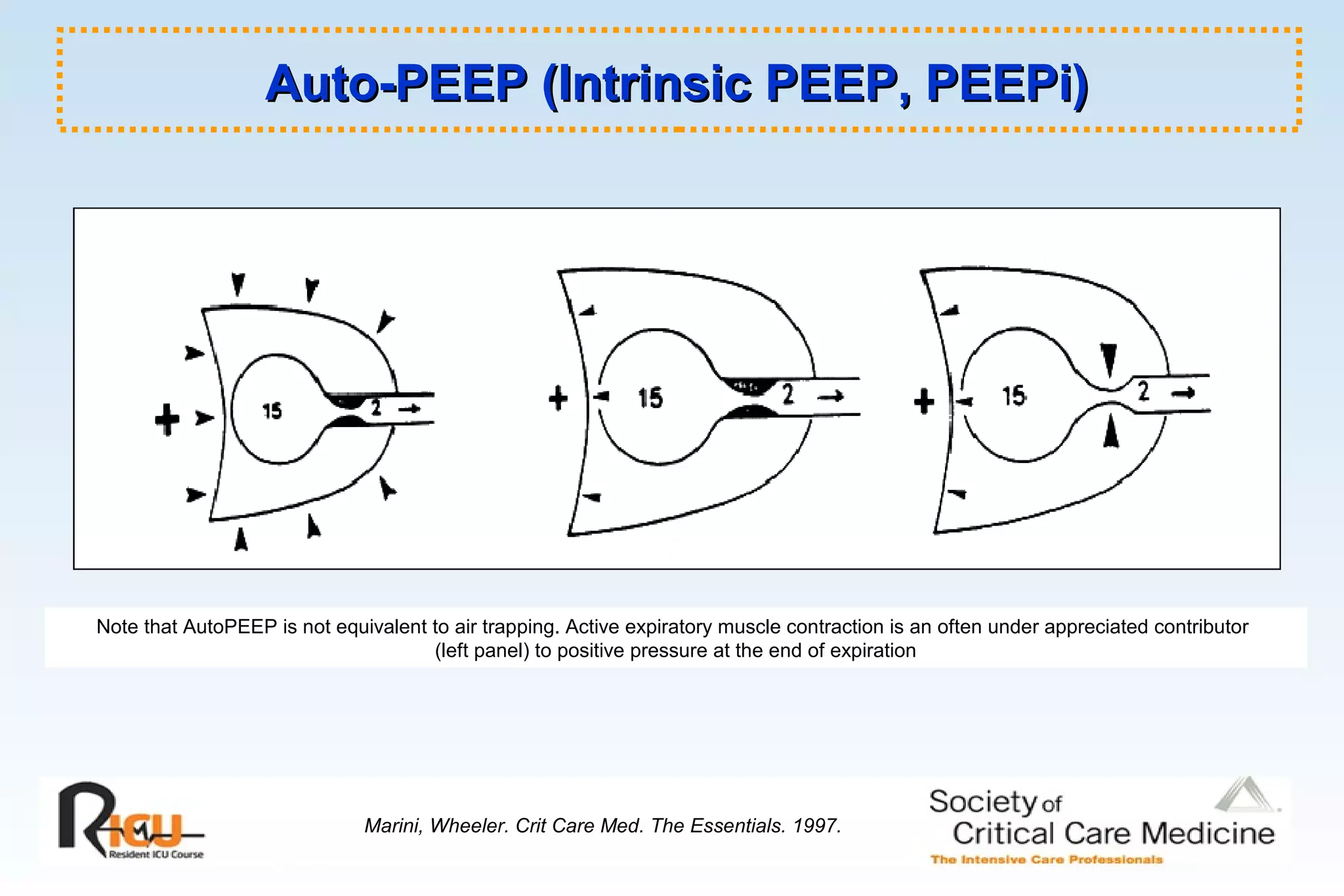 Auto-PEEP (Intrinsic PEEP, PEEPi)Auto-PEEP (Intrinsic PEEP, PEEPi)
Marini, Wheeler. Crit Care Med. The Essentials. 1997.
Note that AutoPEEP is not equivalent to air trapping. Active expiratory muscle contraction is an often under appreciated contributor
(left panel) to positive pressure at the end of expiration
 
