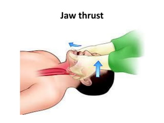 Jaw thrust
 