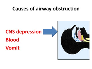 Causes of airway obstruction
CNS depression
Blood
Vomit
 