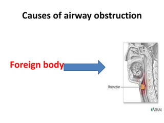 Causes of airway obstruction
Foreign body
 