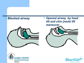  Blocked airway  Opened airway by head
tilt and chin (neck) lift
maneuver
 