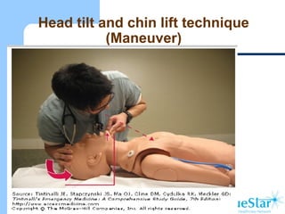 Head tilt and chin lift technique
(Maneuver)
 