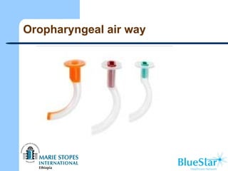 Oropharyngeal air way
 