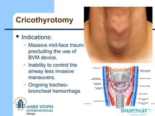 Cricothyrotomy
 Indications:
– Massive mid-face trauma
precluding the use of
BVM device.
– Inability to control the
airway less invasive
maneuvers.
– Ongoing tracheo-
broncheal hemorrhage
 