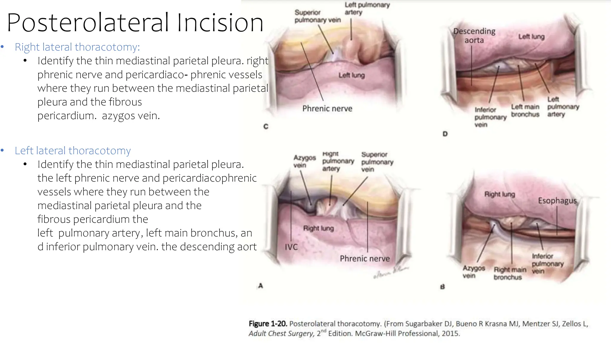 Lateral Utility Incision basic anatomi for toracic surgery 1.pptx