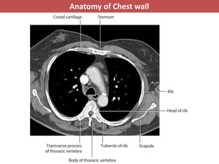 Basic anatomy & Radiology for breast cancer case | PPTX